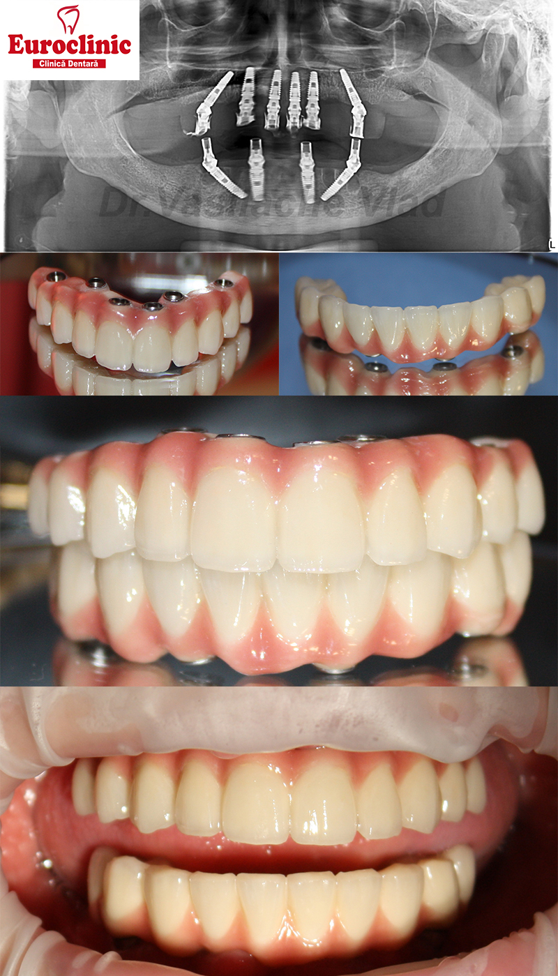 #Dr.VasilacheVlad, #Euroclinic, #Oradeae, #Allon4, #Allon6, #ZironiaBridge, #Implantdentar