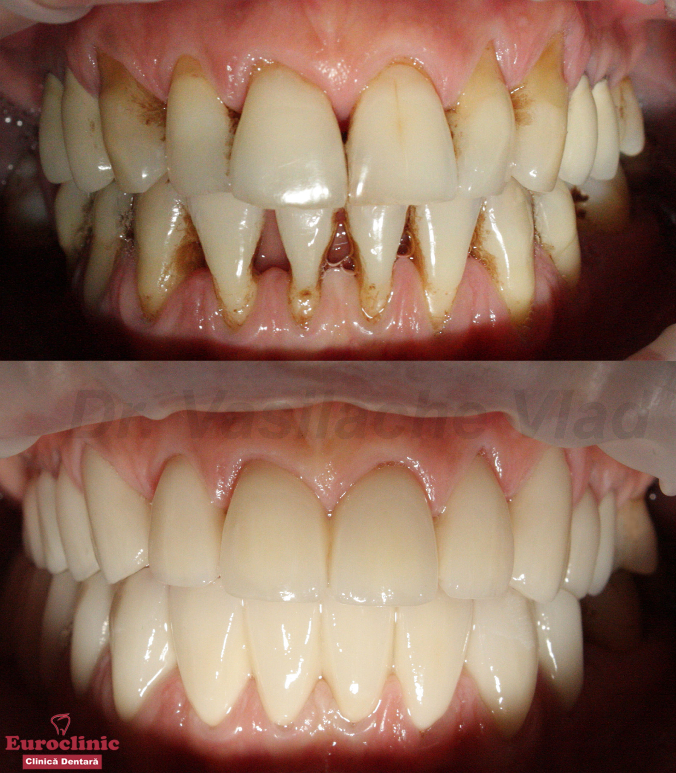 #euroclinic,dr.vasilache,implantdentar,zirconiu,portelan,oradedae