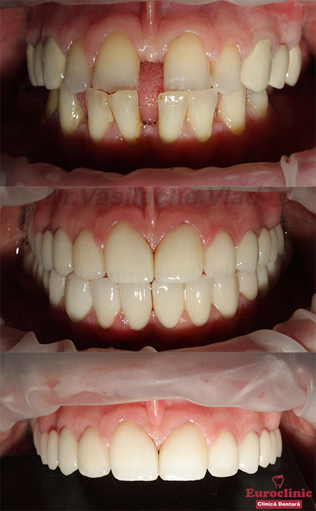 #euroclinic,Dr.Vasilachevlad,implantdentar,oradea,zirconiu,oradeae