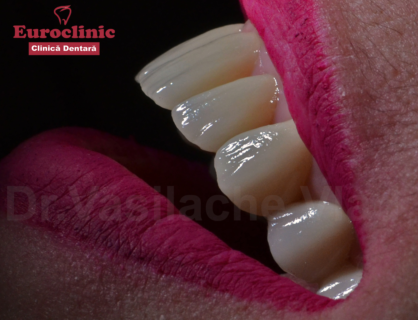 #Euroclinic.oradea.dentist.implant.dentar.fatate.estetica.dentara.portelan.urgente .stomatolog.stomatologie.vasilache.vlad