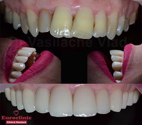 Euroclinic.Oradea.Dr.Vasilache.Vlad.VasilacheVlad.implant.dentar.estetica.dentara.zirconiu.stomatologie.oradea.clinica.dentara.stomatolog.implantologie