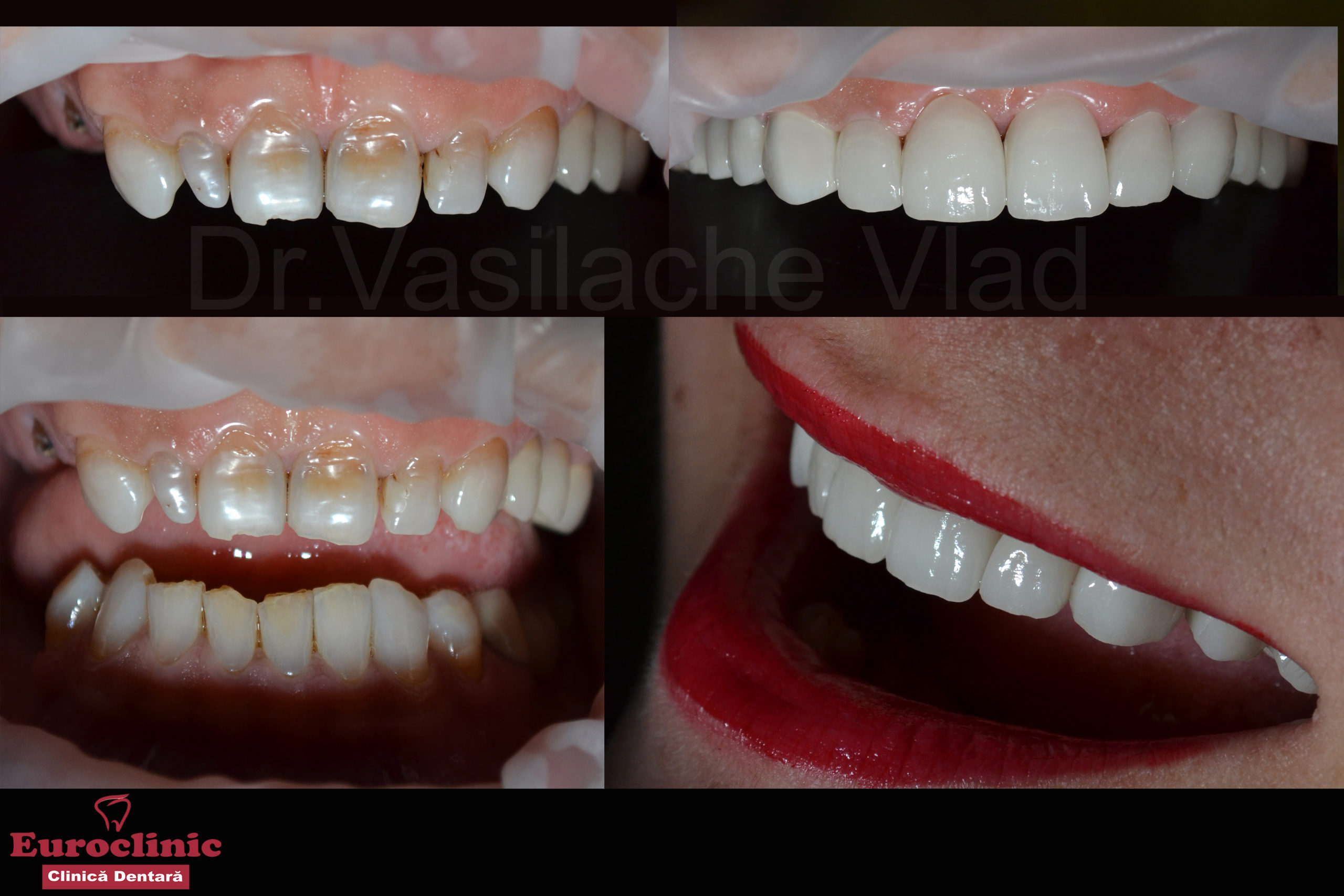 Euroclinic.Oradea.Vasilache.Vlad.Estetica.dentara.stomatologie.zirconiu.implant.dentar.ceramica.fatete.jpg