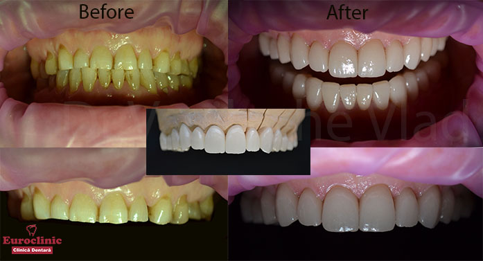 Vasilache.Vlad.euroclinic.oradea.implant.dentar.implantdentar.esteticadentara.estetica.dentara.portelan.implantologie.venner.fatete.dentare.clinica.dentara