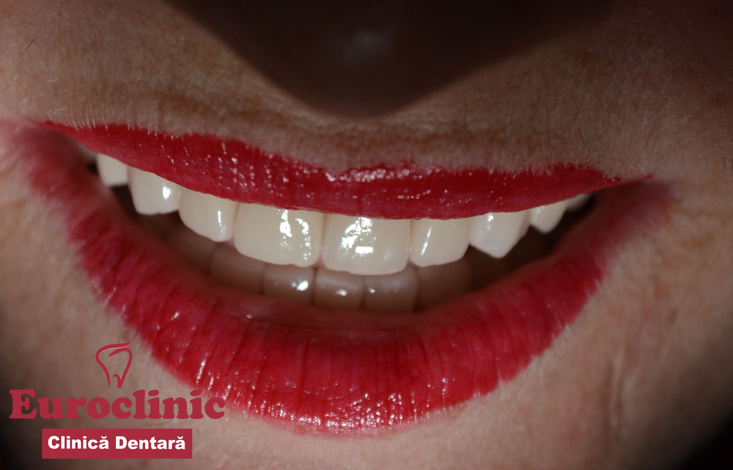 Vasilache.Vlad.euroclinic.oradea.implant.dentar.implantdentar.esteticadentara.estetica.dentara.portelan.implantologie.venner.fatete.dentare.clinica.dentara2